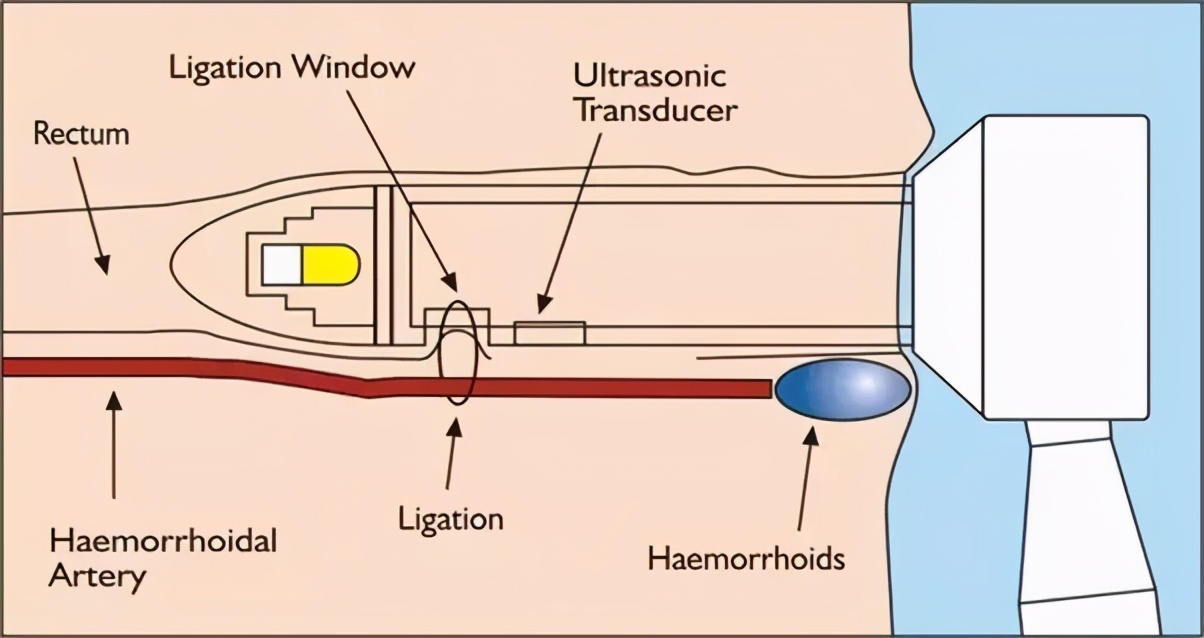 痔疮手术当天去医院就能做吗,两天后能出院的痔疮手术