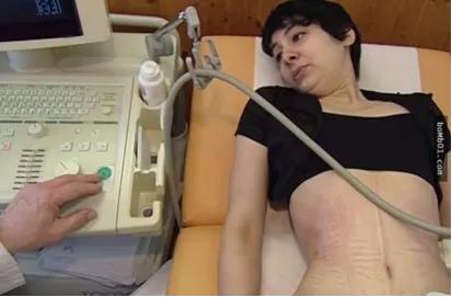 戴束腰子宫下垂,网红束腰导致内脏下垂