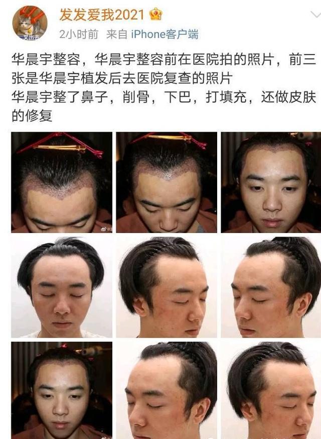 华晨宇到底植发过吗,华晨宇是否植发