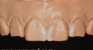 门牙缝可以补吗,为什么门牙有缝