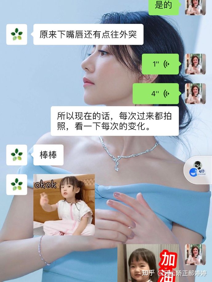 上海成人牙齿矫正失败案例,上海牙齿矫正郝婷婷医生