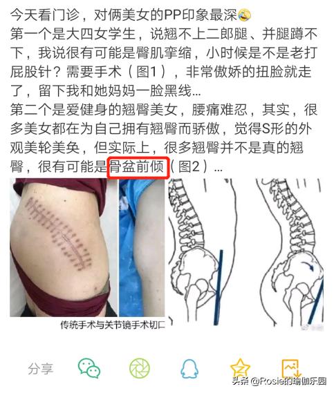 如何知道是真翘臀还是假翘臀,真翘臀和假翘臀是怎么判断的