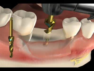 下颌缺失四颗牙修复案例,智齿移植修复缺失牙