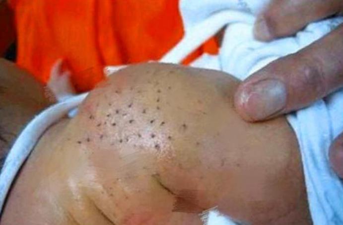 婴儿身上长黑刺家里老人非要去刮,小孩身上出现小黑刺