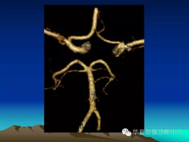 小脑血管解剖分段,脑血管影像解剖讲解