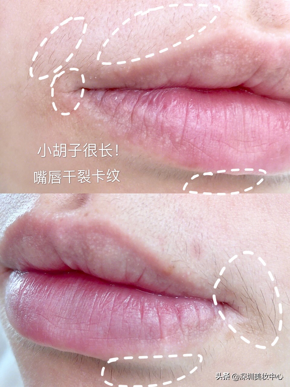 女孩如何消除嘴上的胡子,女生嘴唇去胡子妙招