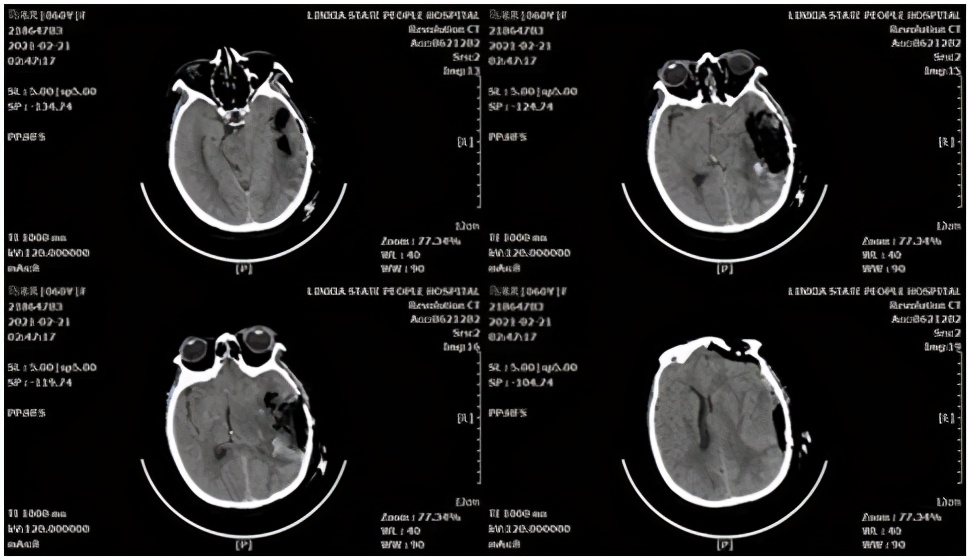 基层医院神经外科微创脑出血前景,高血压脑出血新突破