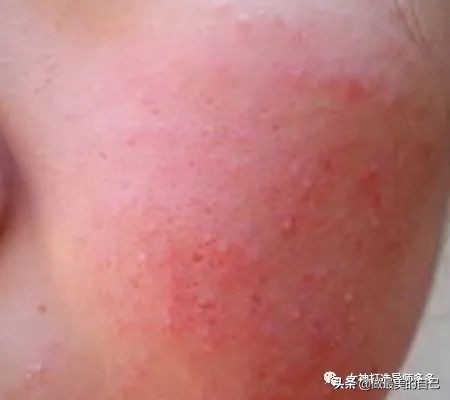 痘印长期不消怎么办,痘印反复消不下去怎么办