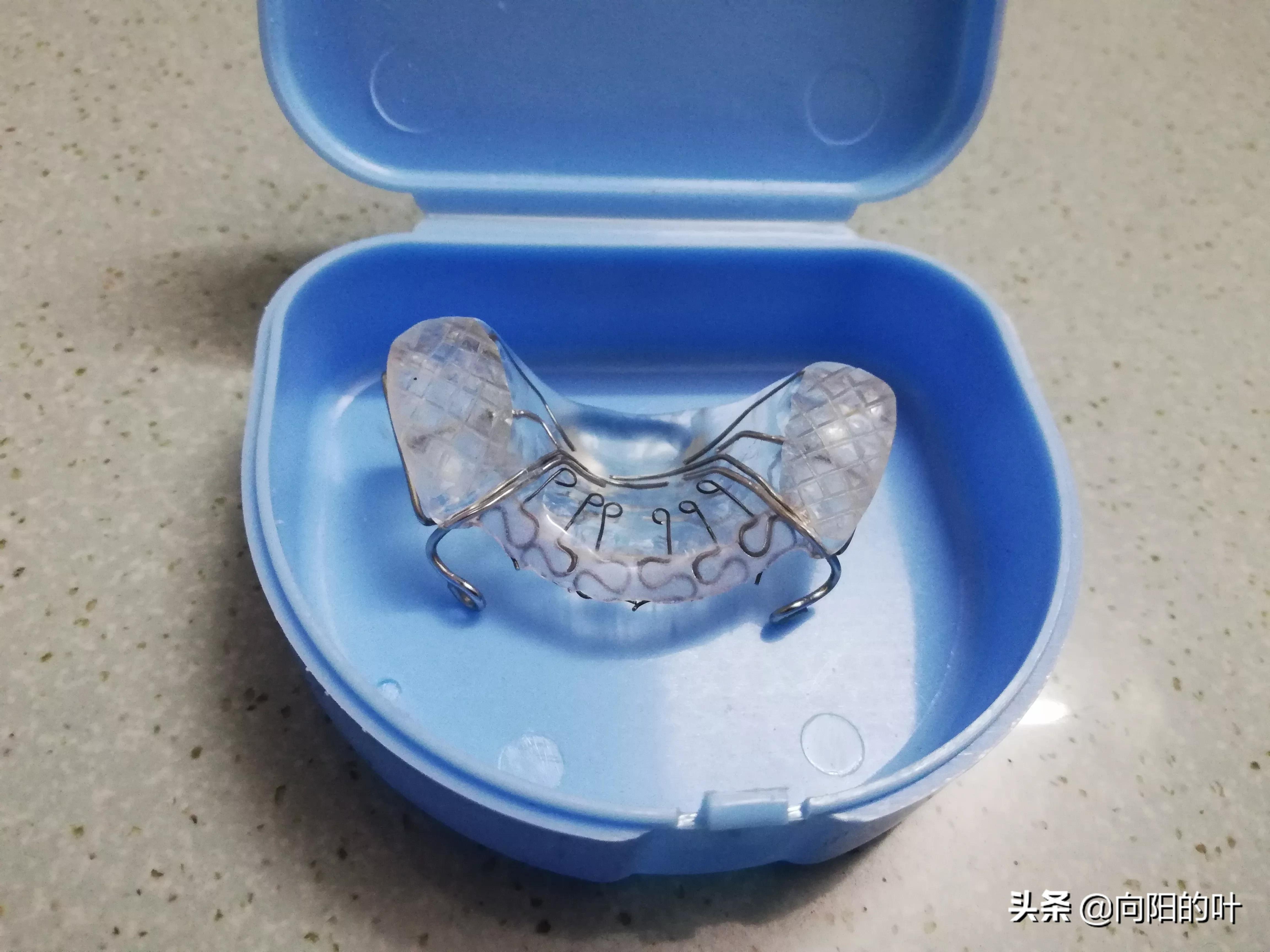 记录小儿兜牙治疗:开始带牙套了