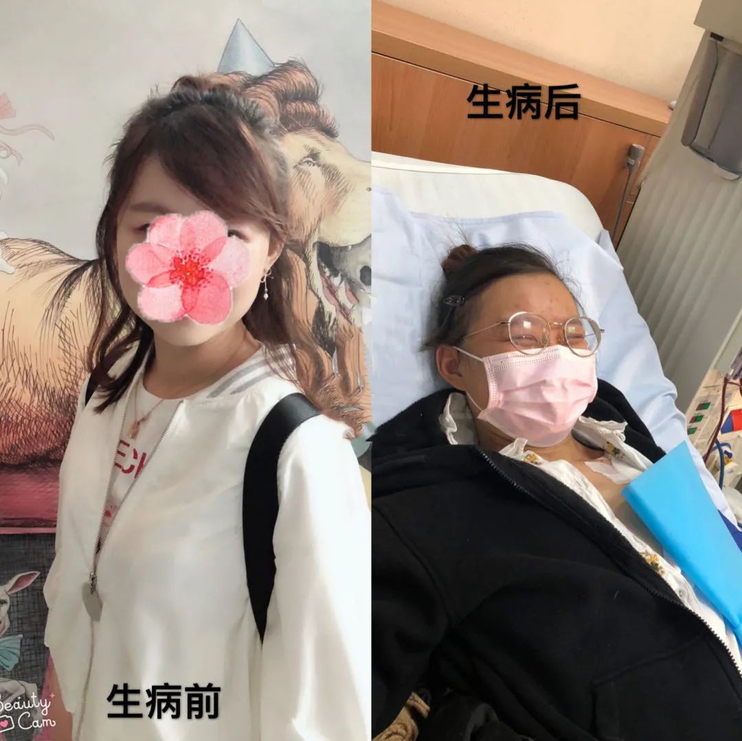 肾炎肌酐200能治愈吗,慢性肾炎肌酐多少需要透析