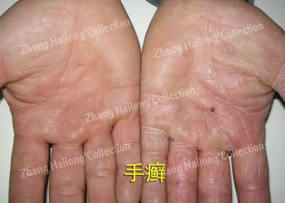 手特别干燥粗糙会是手癣吗,得了手癣指头皮肤变粗糙怎么办