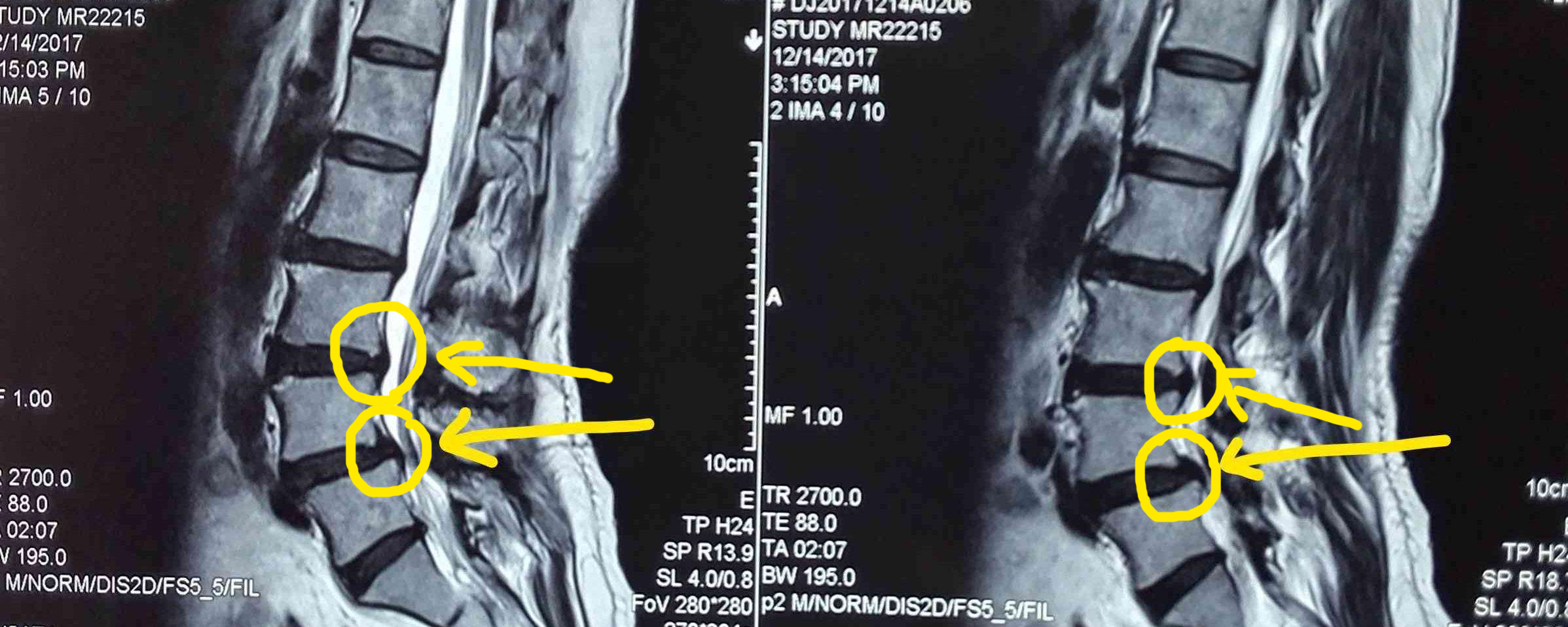 初发腰间盘突出症该如何保健？赶快学起来，否则严重了只能手术