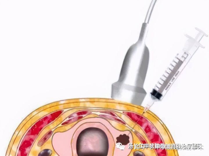 微波消融术后死亡的肿瘤怎么处理,微波消融治疗肿瘤的原理