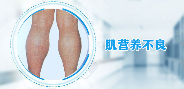 肌营养不良中医怎么治疗自愈,治疗肌营养不良最新药物