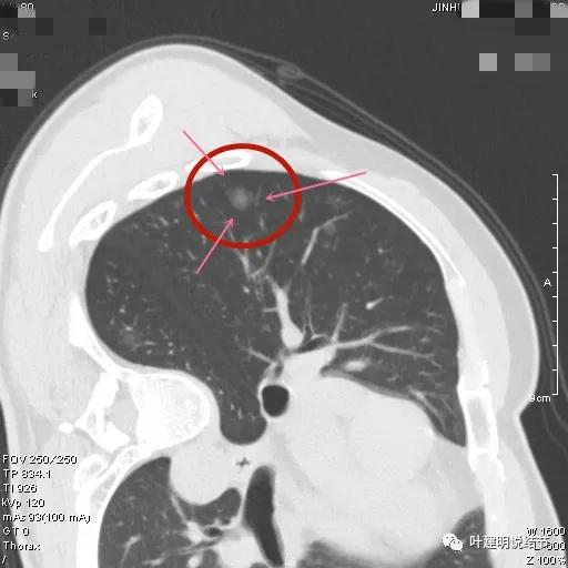 怎样从病理报告看是不是原位癌,原位腺癌切除子宫要开刀吗