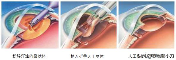 什么手术对白内障最好,老人家最先进的白内障手术过程