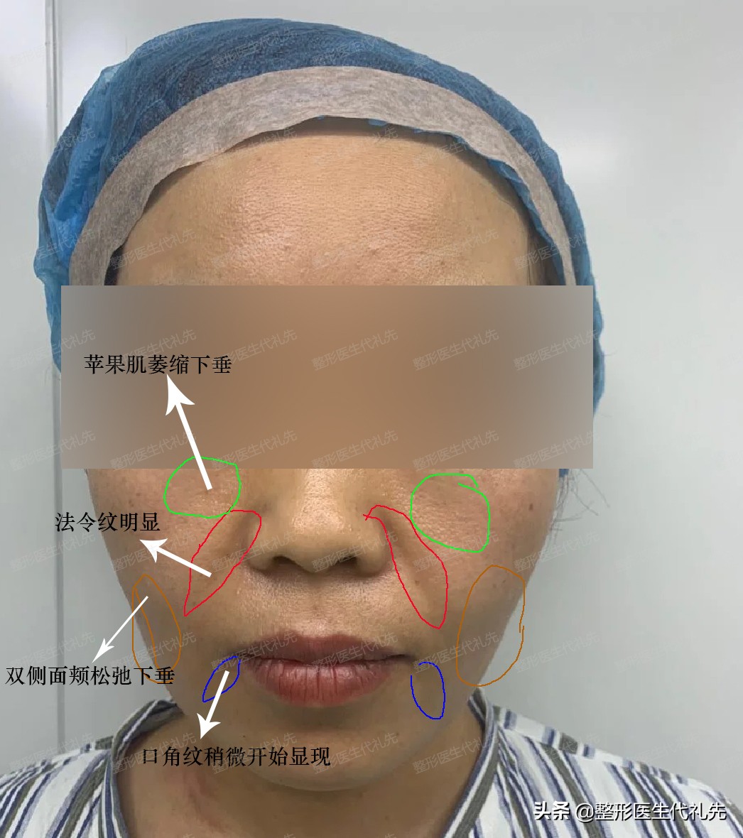 从整形医生的角度来聊一聊形成法令纹的原因以及改善方案