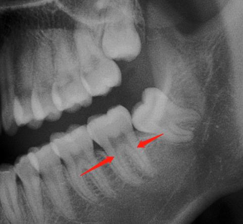 你们做根管治疗花了多少钱,根管治疗做了真的有用吗