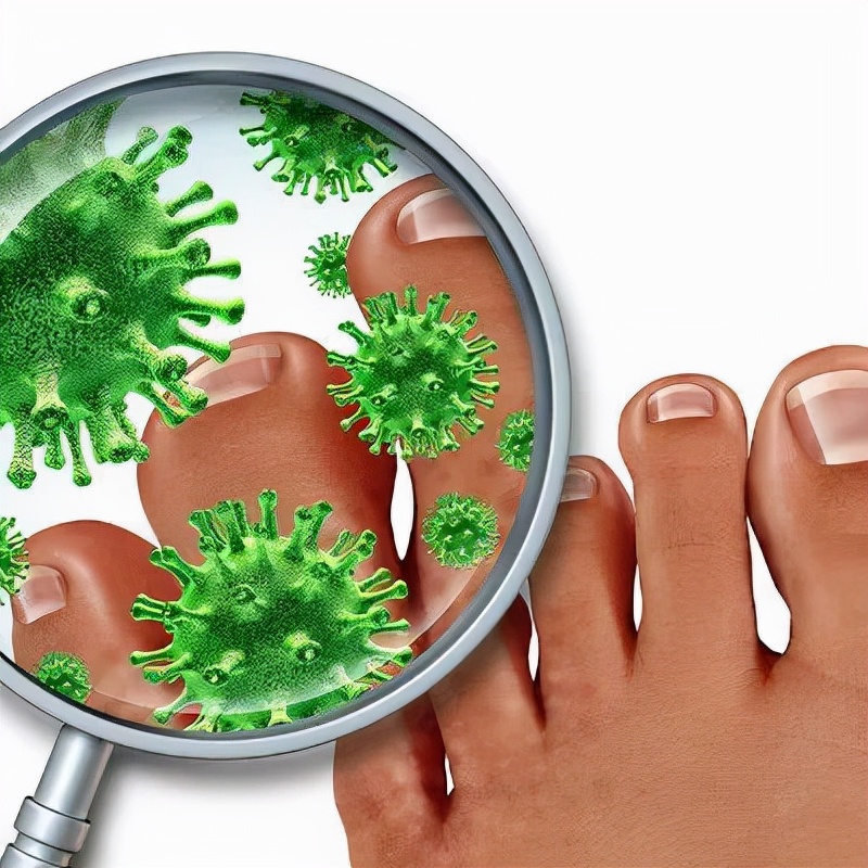 手足癣总是反复怎么治才能除根,手足癣是什么原因引起的怎么解决