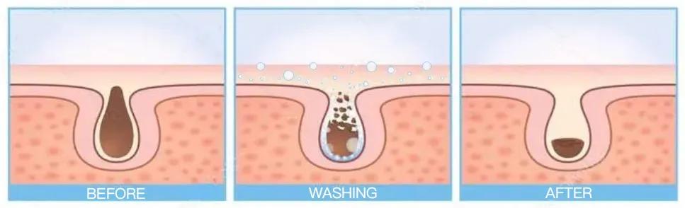 油性肌肤应该怎么样去除黑头,油腻皮肤毛孔粗大黑头多怎么清理