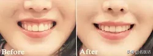 牙周炎才是牙齿松动的罪魁祸首,牙周炎导致全部牙齿脱落镶什么牙