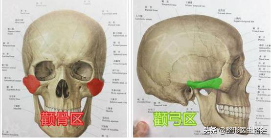 颧骨磨骨苹果肌下垂如何修复,如何判断是苹果肌还是高颧骨