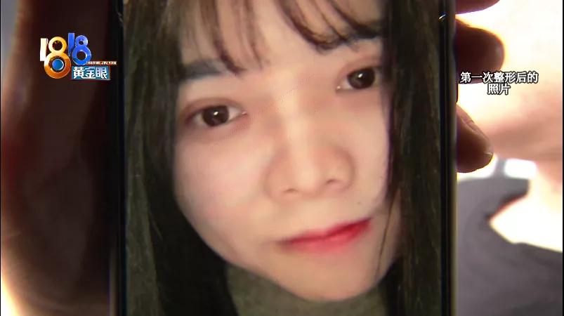 壹加壹做鼻子哪个医生好,壹加壹隆鼻图片