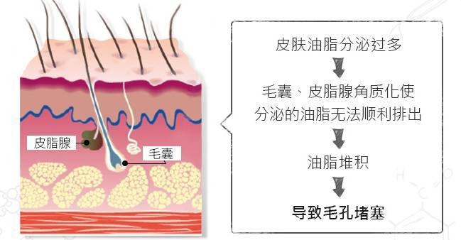 油皮出油用什么补妆,混油皮夏天出油更严重怎么护肤