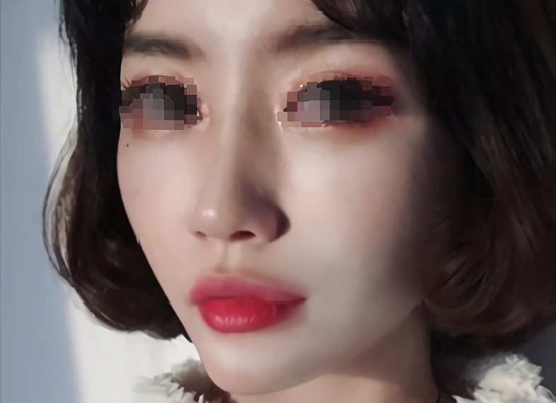 成功的鼻子以后要修复吗,隆鼻修复四次成畸形鼻