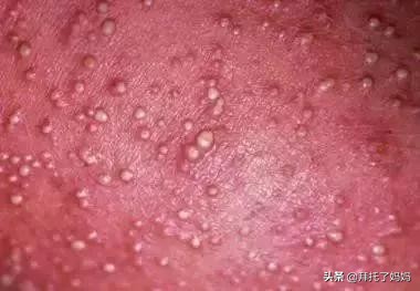 预防痱子小窍门,热痱和痱子的区别