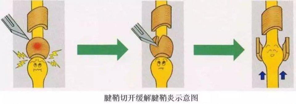 先天性狭窄性腱鞘炎必须手术吗,先天性拇指狭窄性腱鞘炎会遗传吗