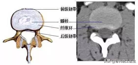 腰间盘突出脚麻腰疼怎么解决,腰间盘突出腰疼的不能动怎么办