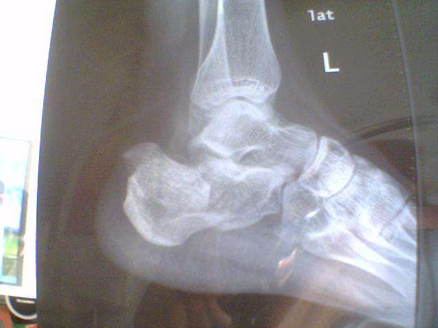 脚跟骨折恢复了怎么练习走路,跟骨骨折保守治疗100天多走路好吗