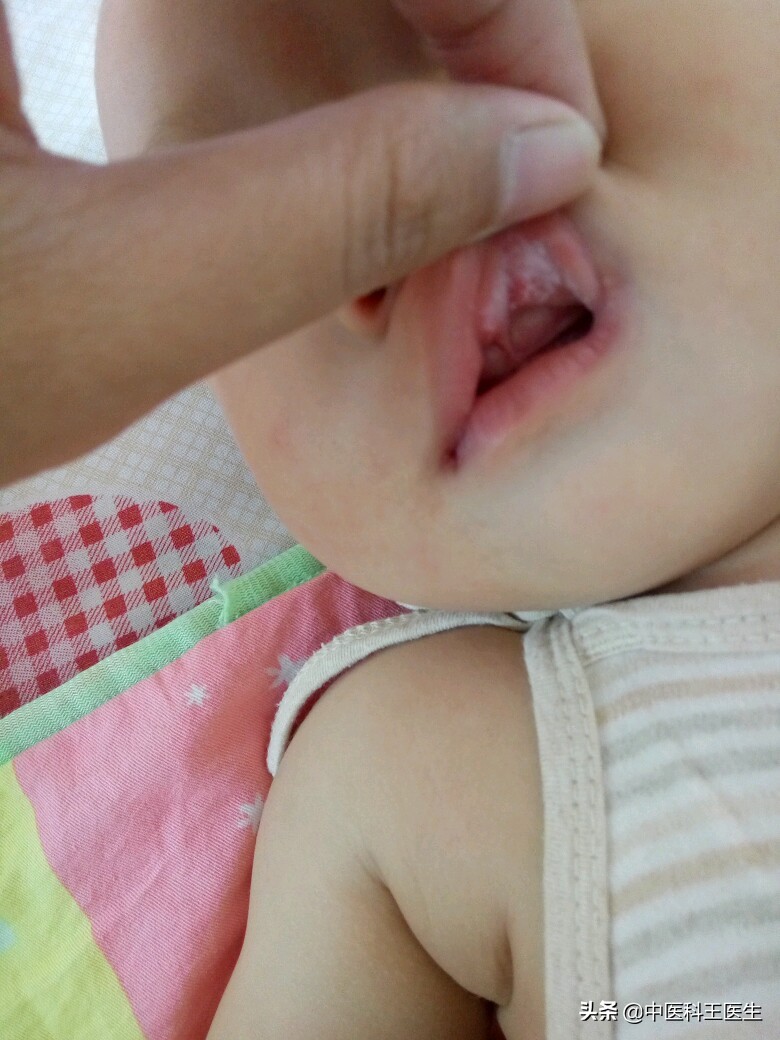 鹅口疮怎么才能不复发吃益生菌,鹅口疮怎么抹药更彻底不容易复发