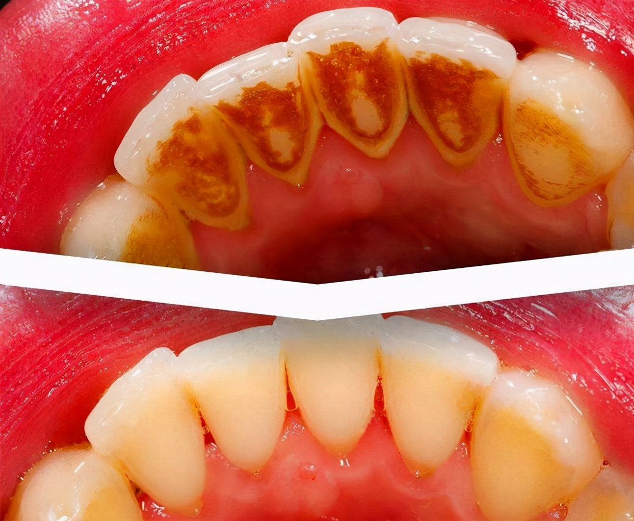 一般看个牙痛多少钱,看个牙包要多少钱