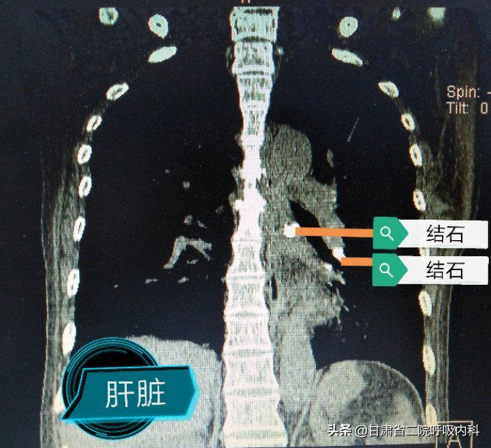 喉咙里面真的有石头吗,喉咙里会长石头吗