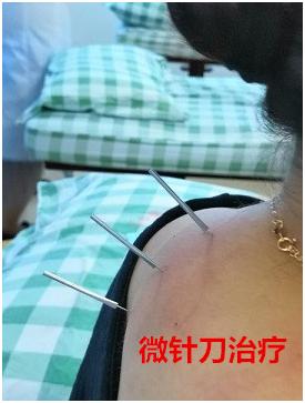 脖子上有富贵包怎么消除,脖子上面长了富贵包应该怎么消除