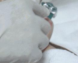 大痘印适合做什么医美,医美做什么可以去除痘坑