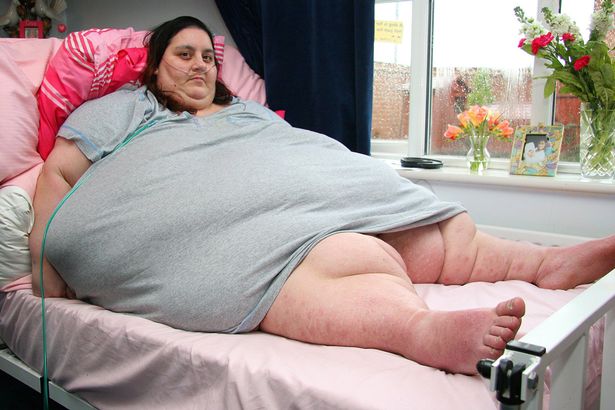 狂吃十年让胖妈器官衰竭，切胃减肥暴瘦66公斤，仍难逃死神索命