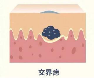 兽皮痣通过什么方式可以查出来,兽皮痣必须治疗吗