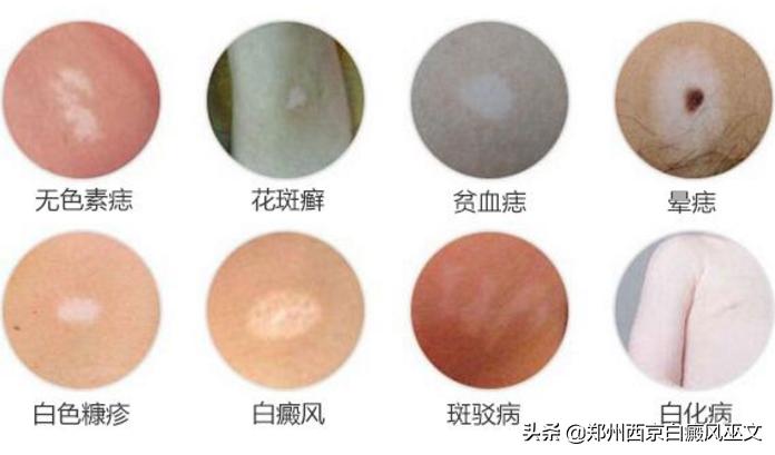 身上的白斑点怎么确定是白癜风,怎么辨别身上的斑块是不是白癜风