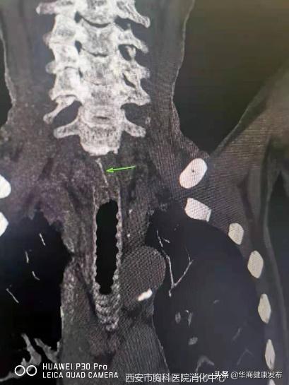 骨鲠,消化内镜可以做什么治疗