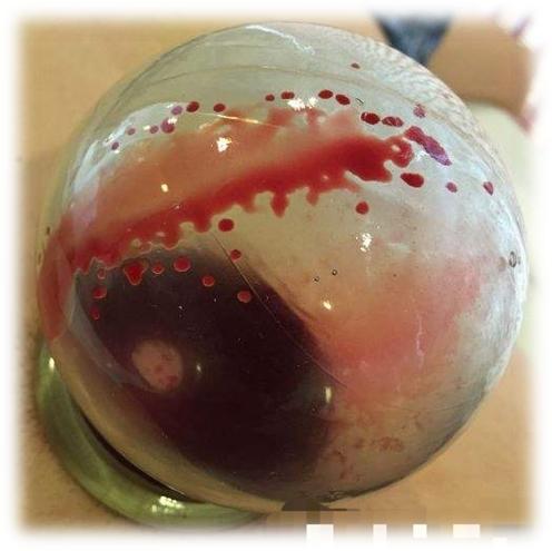 爱助她①丨对于乳腺增生,中医有什么好办法?