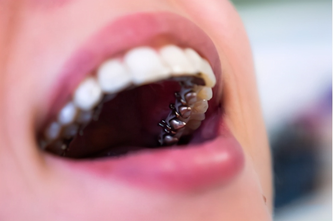 矫正牙齿选择什么托槽好,罗云熙牙齿矫正对比