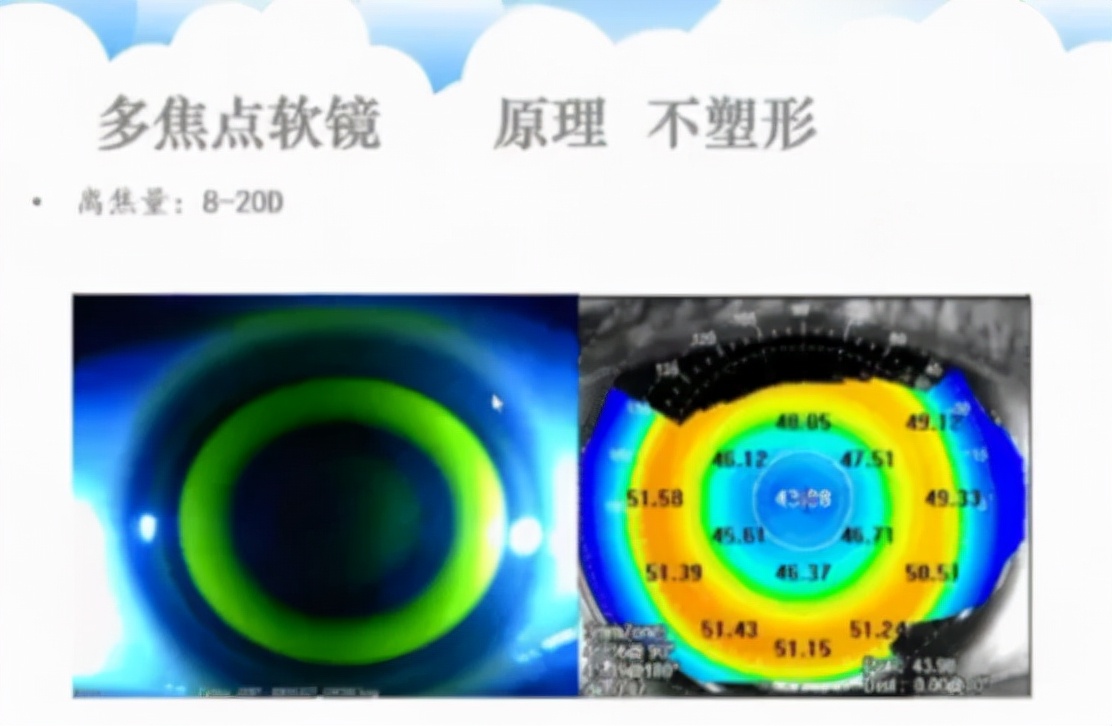 少年屈光不正怎么配镜,屈光参差的配镜原则讲解视频