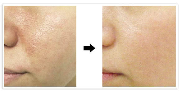 美容微针祛痘印,微针改善毛孔痘印做几次有效果