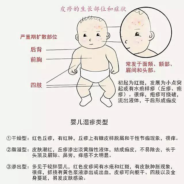 婴幼儿湿疹如何护理崔玉涛,婴幼儿湿疹护理方法
