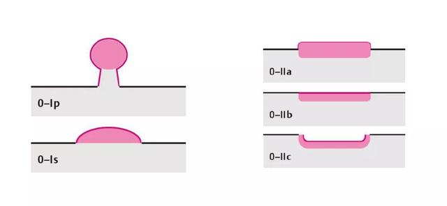 食管癌诊疗规范（2018年版）