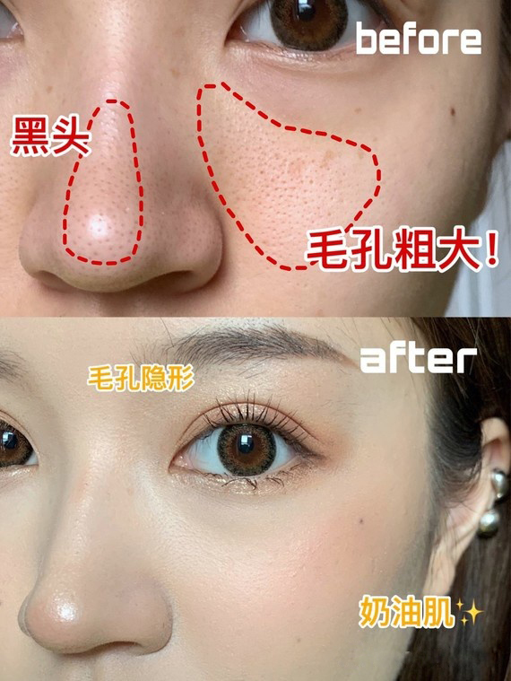 光子嫩肤做了多久可以做果酸换肤，真的能让毛孔收敛吗？