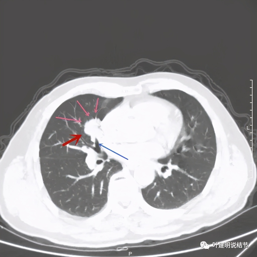 实性结节影要不要紧,实性结节穿刺活检为良性